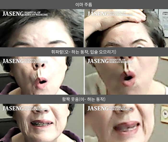 자생한방병원 치료사례 MRI로 보는 치료결과-이마에 주름을 잡을 수 없고, 입술을 오므릴수가 없다.