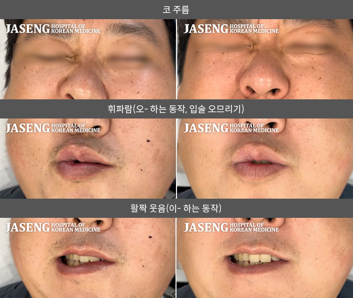 자생한방병원 치료사례 MRI로 보는 치료결과-업무 과로와 스트레스로 인한 안면마비, 구안와사