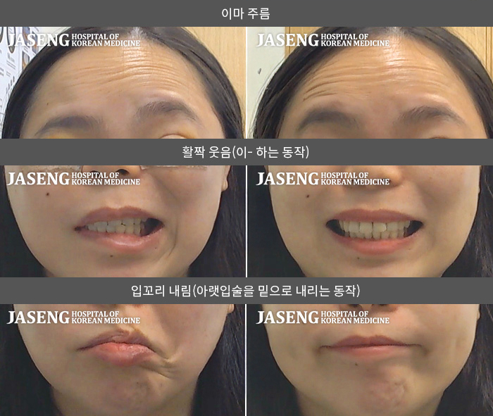 자생한방병원 치료사례 MRI로 보는 치료결과-2024.10.23 쌍꺼풀 수술 전 안면마비 발생 안면마비 진행안되어 수술가능 함 고지 받고 성형수술 후 내원