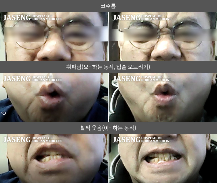 자생한방병원 치료사례 MRI로 보는 치료결과-좌측 코 아래쪽 입 주변부로 무디고 삐뚤어지며, 왼쪽 눈이 잘 안감아져 눈물이 계속나는 구안와사 환자