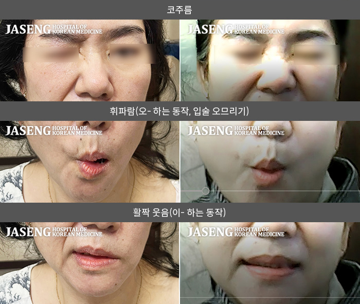 자생한방병원 치료사례 MRI로 보는 치료결과-한쪽 눈이 감기지 않고 입이 틀어진 구완와사