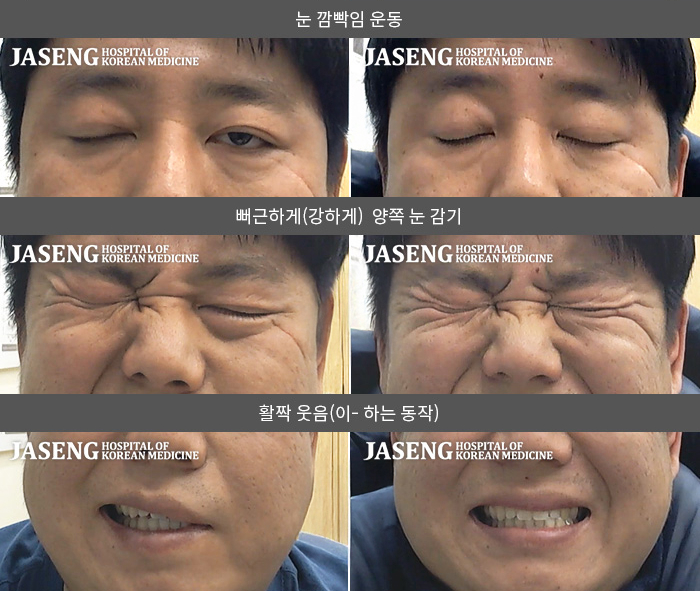 자생한방병원 치료사례 MRI로 보는 치료결과-2025.01.03 좌측안면마비 발생 좌측 눈 깜빡임, 힘주어 눈감기, 활짝 웃음시  좌우비대칭상태로 내원