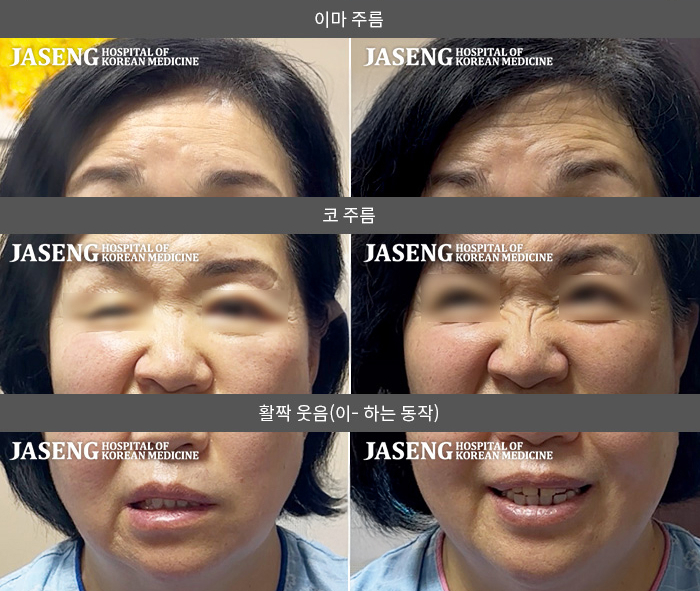 자생한방병원 치료사례 MRI로 보는 치료결과-눈을 감을 수 없고, 입에서 물이 새요.