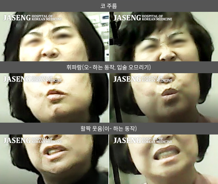 자생한방병원 치료사례 MRI로 보는 치료결과-귀 뒤쪽 통증먼저 시작된 후 나타난  안면마비 증상  (이성대상포진)