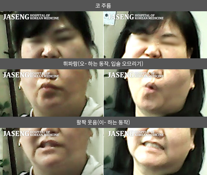 자생한방병원 치료사례 MRI로 보는 치료결과-스트레스 받은 다음 날 , 삐-하는 소리의 이명과 함께 눈이 감기지 않고 입 주변의 힘이 빠지는 증상이 시작되었습니다.