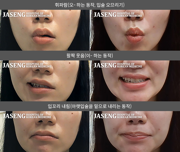 자생한방병원 치료사례 MRI로 보는 치료결과-기상 후 좌측안면마비가 생긴 걸 인지하여 바로 내원하게 되었습니다. 다음날부터 안면마비가 빠르게 진행되었습니다.