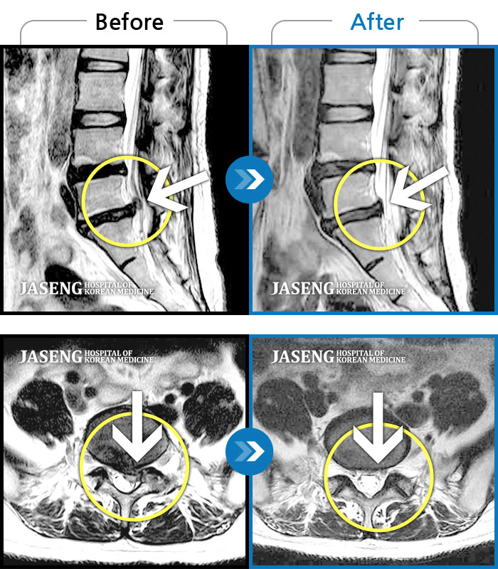 자생한방병원 치료사례 MRI로 보는 치료결과-허리 양측과 우측 둔부 통증, 좌측 하지 후면으로 저림