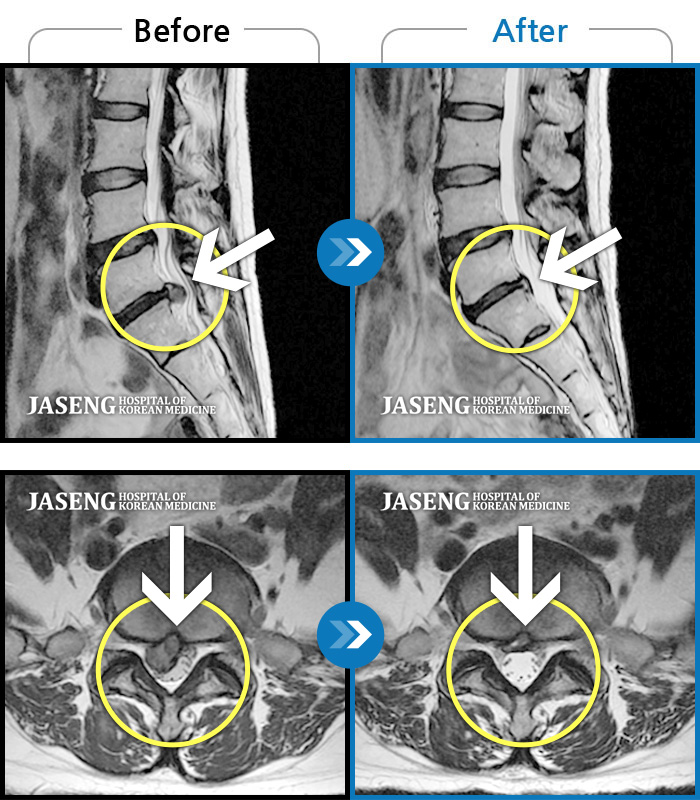 자생한방병원 치료사례 MRI로 보는 치료결과-우측 엉치 부위 통증과 종아리와 발로 이어지는 통증