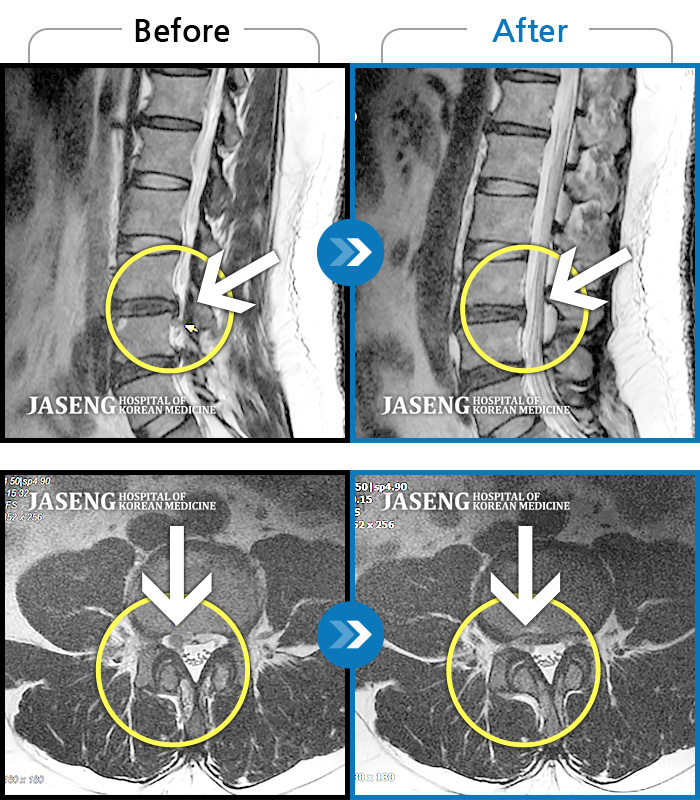 자생한방병원 치료사례 MRI로 보는 치료결과-앉았다 일어나면 통증 발생, 앉아서 근무할 때 다리 저림