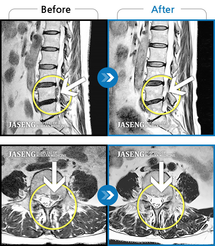 자생한방병원 치료사례 MRI로 보는 치료결과-내원시 하부 요추 통증으로 보행 불가하고 야간통증
