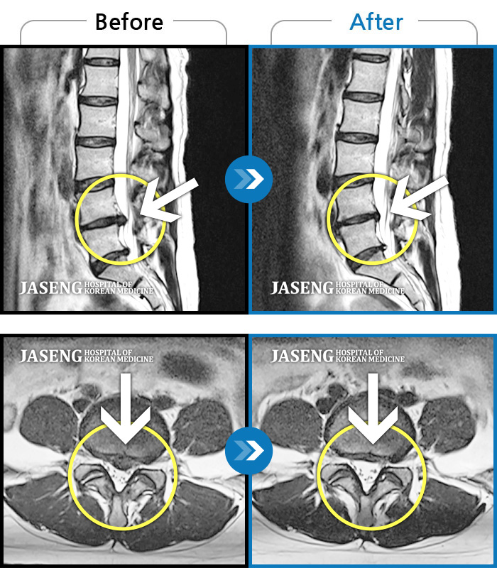 자생한방병원 치료사례 MRI로 보는 치료결과-허리 중간부위 통증, 간헐적으로 양측 엉치 부위 저림