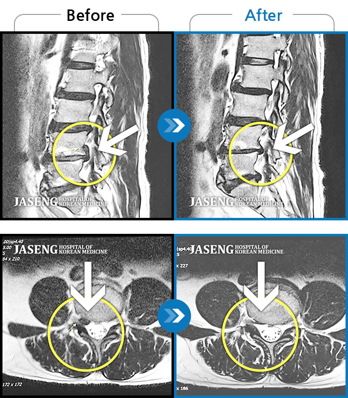 자생한방병원 치료사례 MRI로 보는 치료결과-허리 골반 통증, 우측 다리에서 종아리까지 저리고 당김, 야간통