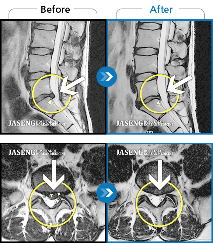 자생한방병원 치료사례 MRI로 보는 치료결과-허리 골반 통증, 좌측 다리가 뒤로 당김
