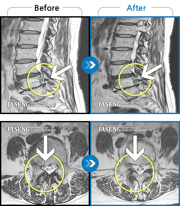 자생한방병원 치료사례 MRI로 보는 치료결과-허리 골반통증 및 우하지 방사통