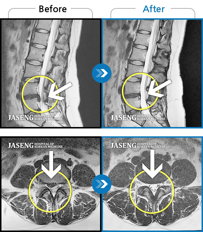 자생한방병원 치료사례 MRI로 보는 치료결과-허리 및 우측 하지 통증