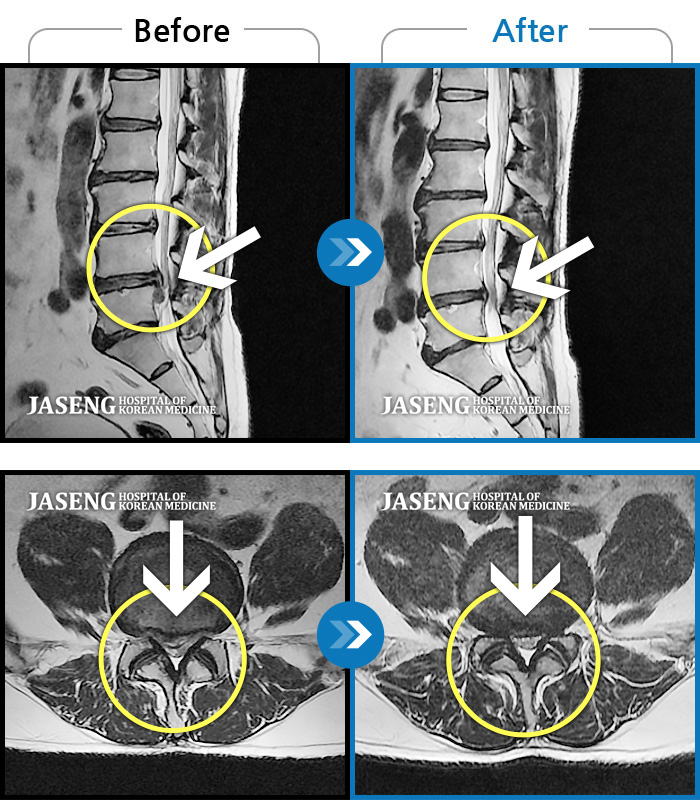 자생한방병원 치료사례 MRI로 보는 치료결과-허리 및 우측 하지 통증