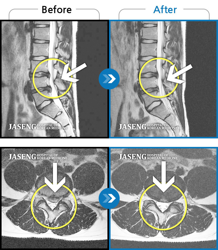 자생한방병원 치료사례 MRI로 보는 치료결과-허리디스크로 인한 요통, 좌측 하지방사통
