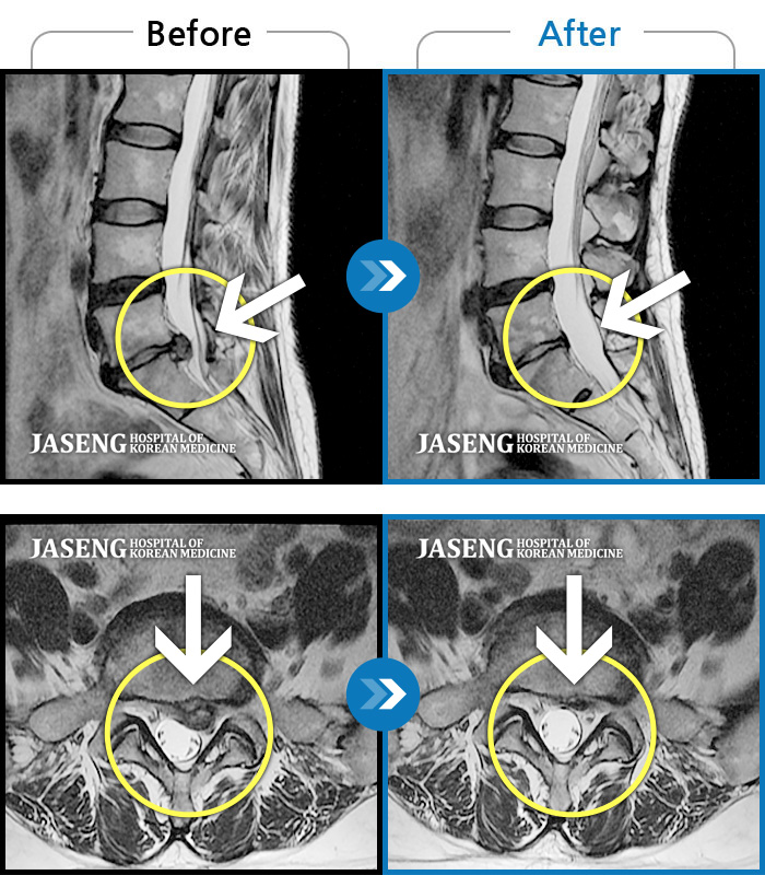 자생한방병원 치료사례 MRI로 보는 치료결과-요부 및 좌하지 통증으로 기상 후 통증
