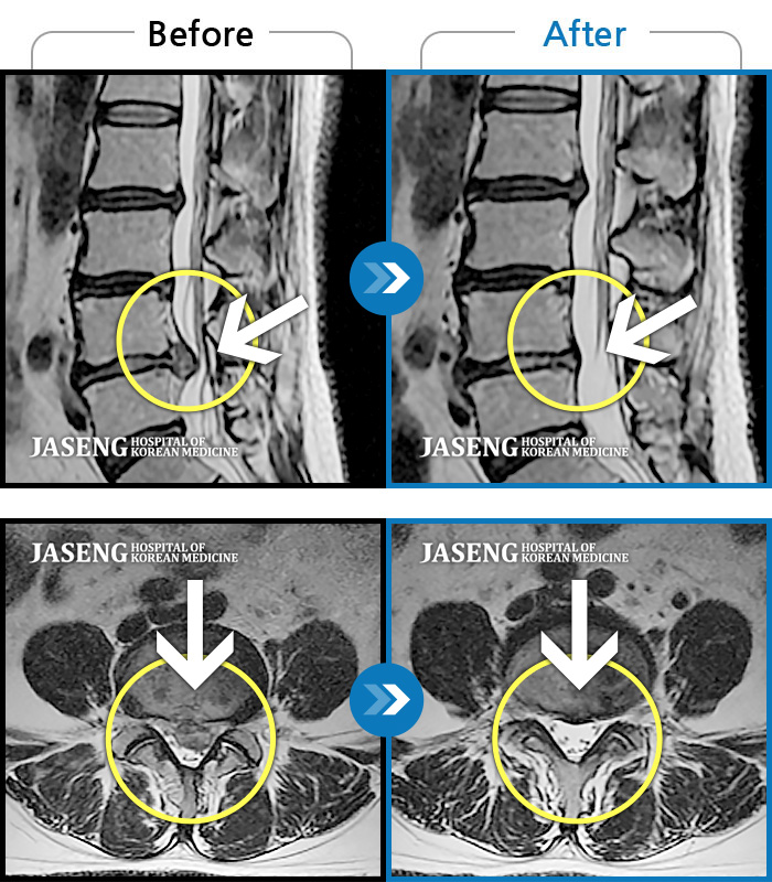 자생한방병원 치료사례 MRI로 보는 치료결과-좌측 허리 통증, 좌측 다리로 저린감, 당기는 통증