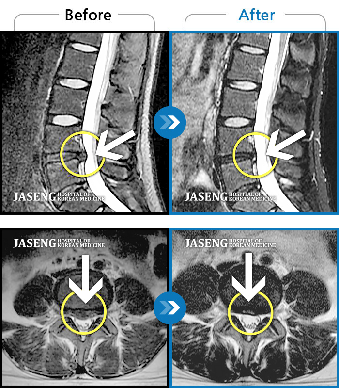 자생한방병원 치료사례 MRI로 보는 치료결과-통증으로 거동 불편