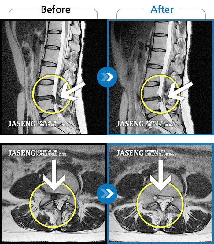자생한방병원 치료사례 MRI로 보는 치료결과-심한 허리 통증과 우측 다리 통증