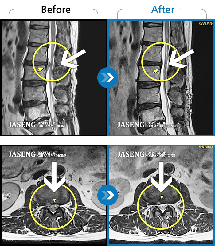 자생한방병원 치료사례 MRI로 보는 치료결과-좌측 허리 통증, 좌측 하지 뒤쪽으로 저림 증상