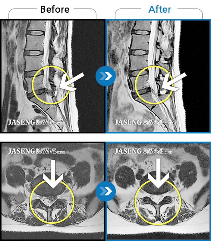 자생한방병원 치료사례 MRI로 보는 치료결과-좌측 엉덩이 통증 및 허벅지 당김 증상