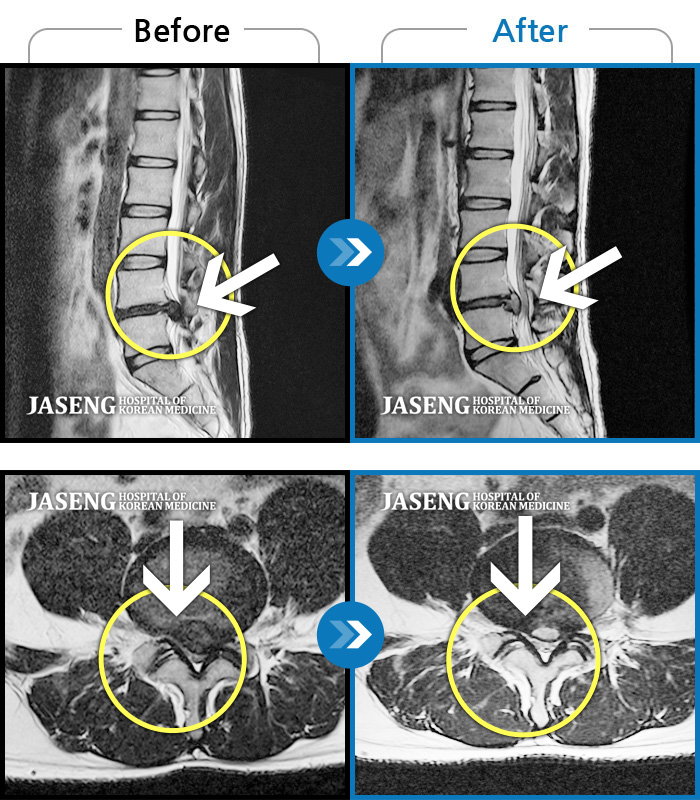 자생한방병원 치료사례 MRI로 보는 치료결과-엉치 통증, 좌측 다리 저림