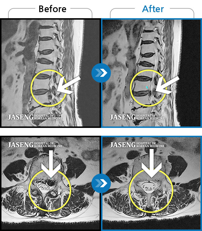 자생한방병원 치료사례 MRI로 보는 치료결과-좌측 허리 통증 및  좌측 다리 저림