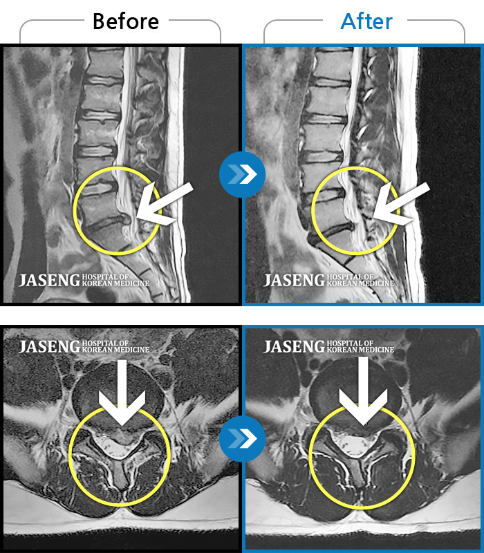 자생한방병원 치료사례 MRI로 보는 치료결과-허리와 좌측 엉치 통증