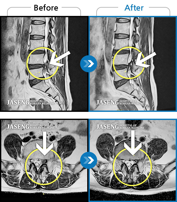 자생한방병원 치료사례 MRI로 보는 치료결과-허리 좌측 골반에서 발목으로 통증, 저린감, 쥐나는 증상