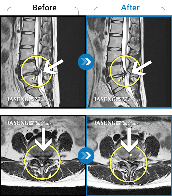 자생한방병원 치료사례 MRI로 보는 치료결과-허리 양측 골반에서 좌측 발가락까지 통증, 저림 증상
