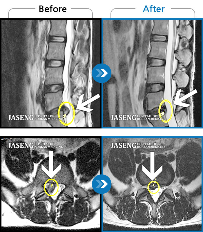 자생한방병원 치료사례 MRI로 보는 치료결과-양쪽 허리, 엉치, 골반쪽으로 불편감, 우측 다리 저림
