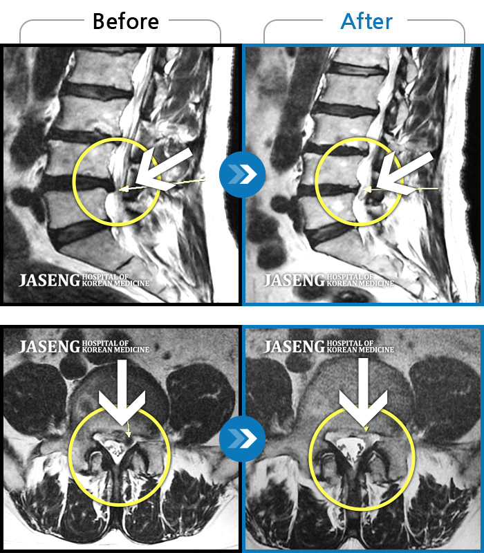 자생한방병원 치료사례 MRI로 보는 치료결과-요통과 좌측 하지부 통증