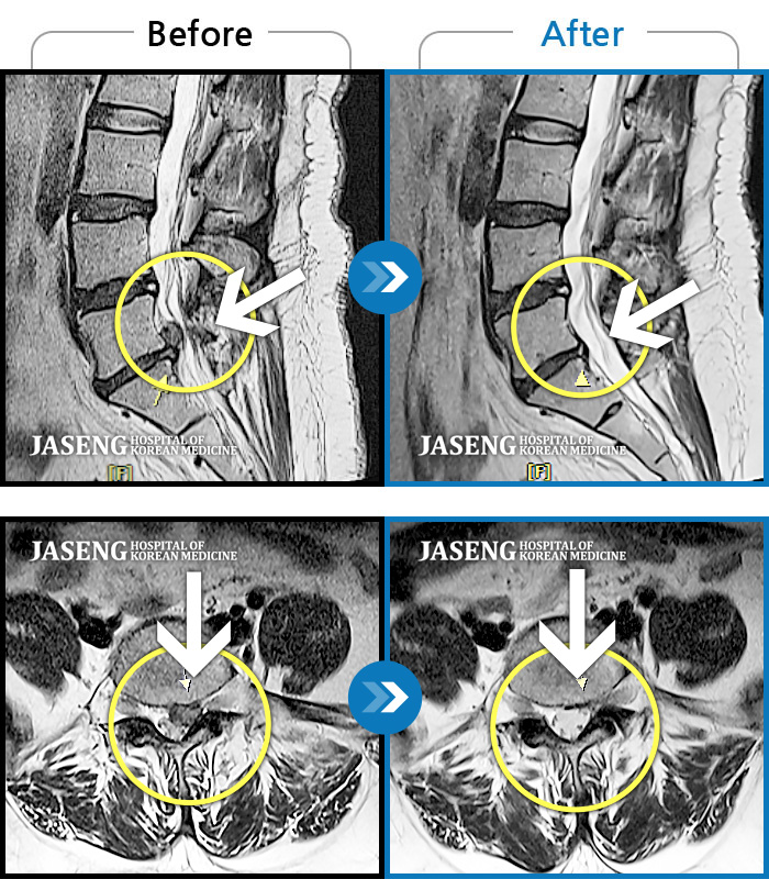 자생한방병원 치료사례 MRI로 보는 치료결과-허리 좌측에서 종아리 후면까지 통증, 묵직한 증상