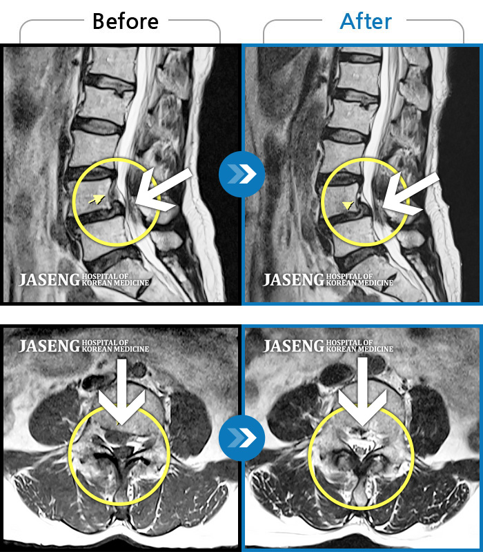 자생한방병원 치료사례 MRI로 보는 치료결과-허리 양측 골반에서 우측 허벅지 외측으로 통증, 5분 정도 기립 시 당기고 저리는 증상