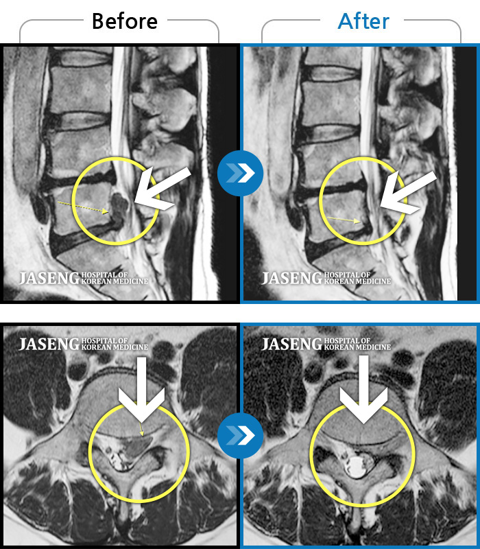 자생한방병원 치료사례 MRI로 보는 치료결과-허리디스크 통증으로 내원