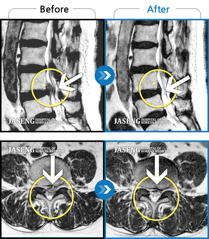 자생한방병원 치료사례 MRI로 보는 치료결과-허리통증, 왼쪽 다리 저림 및 근력 저하