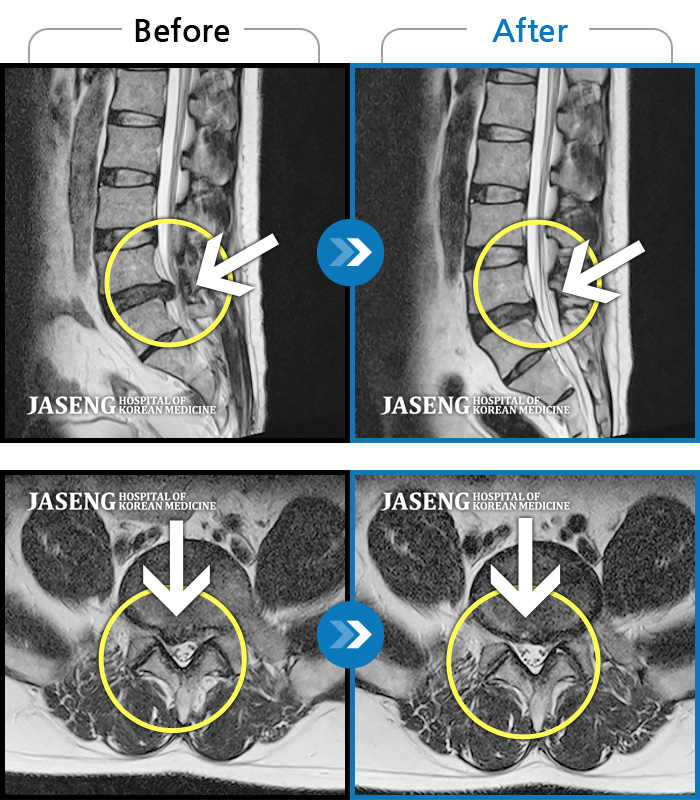 자생한방병원 치료사례 MRI로 보는 치료결과-종아리 통증
