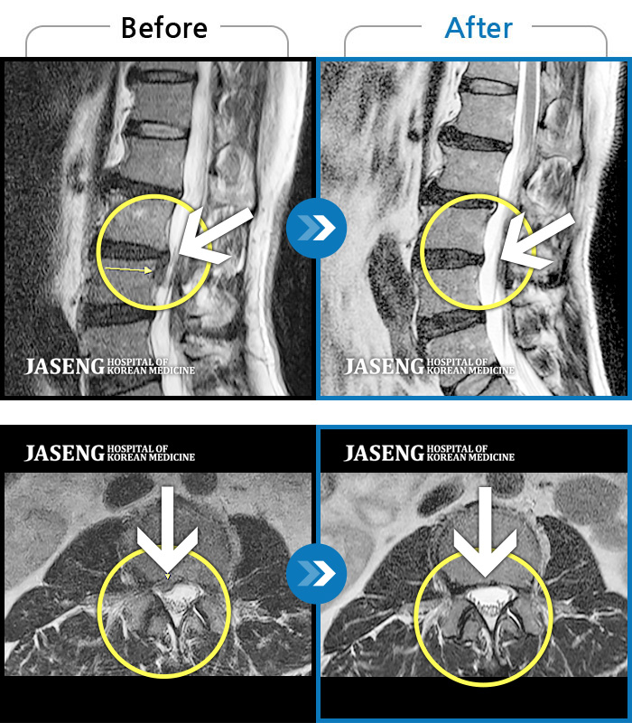 자생한방병원 치료사례 MRI로 보는 치료결과-허리, 골반, 우측 다리 통증, 야간통