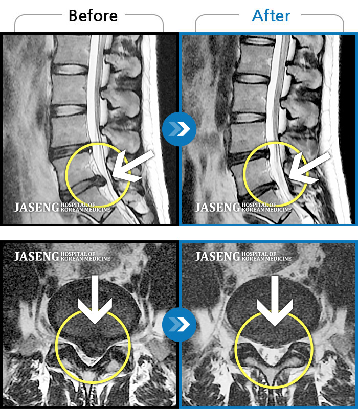 자생한방병원 치료사례 MRI로 보는 치료결과-요통과 좌측 하지방사통으로 내원
