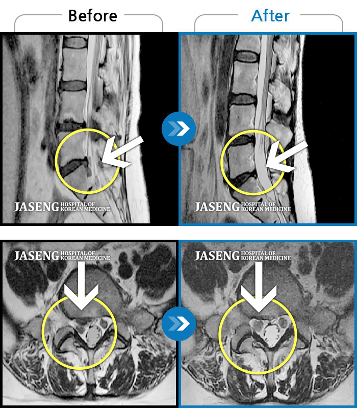 자생한방병원 치료사례 MRI로 보는 치료결과-허리 통증 및 몸이 앞으로 굽혀지지 않음