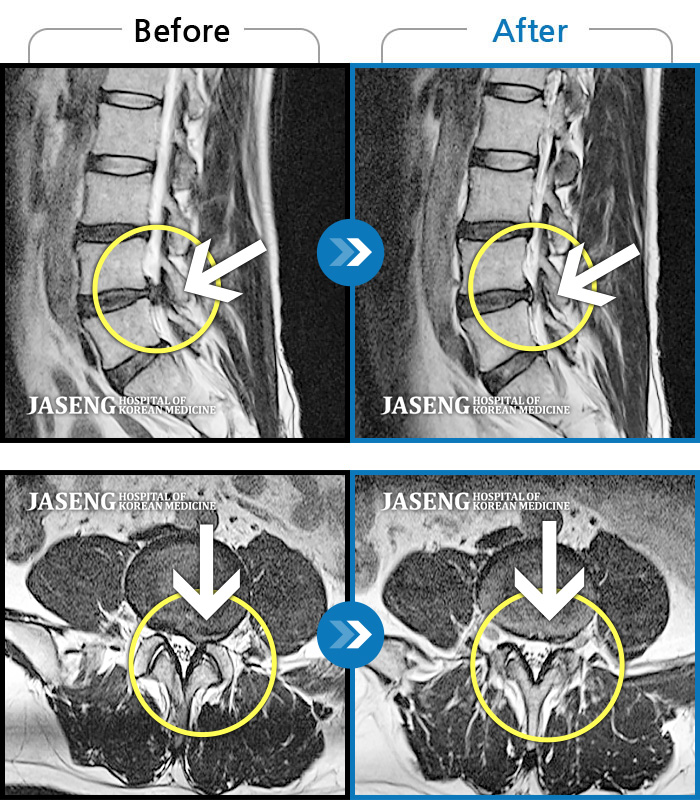 자생한방병원 치료사례 MRI로 보는 치료결과-허리 뻐근한 통증과 왼쪽 종아리 저림