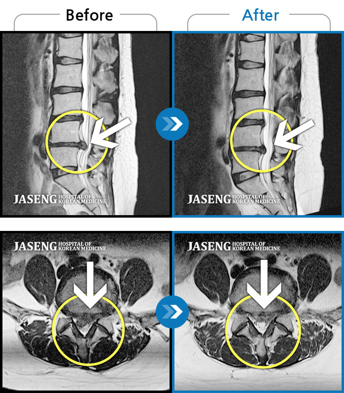 자생한방병원 치료사례 MRI로 보는 치료결과-기침하면 허리 통증 발생, 몸을 비틀면 우측 허벅지에서 종아리까지 통증