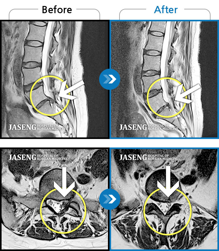 자생한방병원 치료사례 MRI로 보는 치료결과-허리 통증과 왼쪽 골반에서 종아리까지 당기는 통증