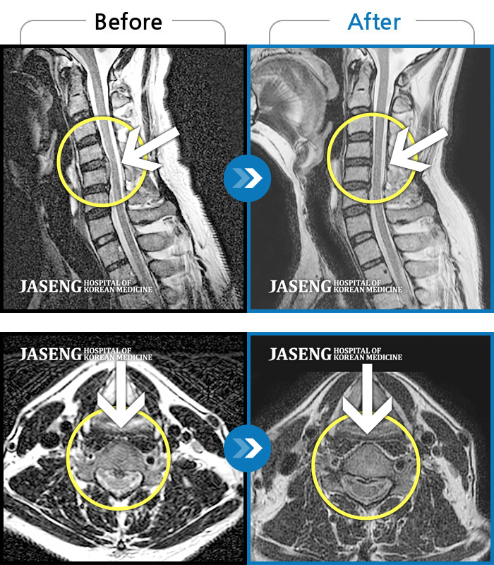 자생한방병원 치료사례 MRI로 보는 치료결과-허리디스크 치료하는 동안 예전에 치료 받았던 목디스크도 확인해보고 싶어요”