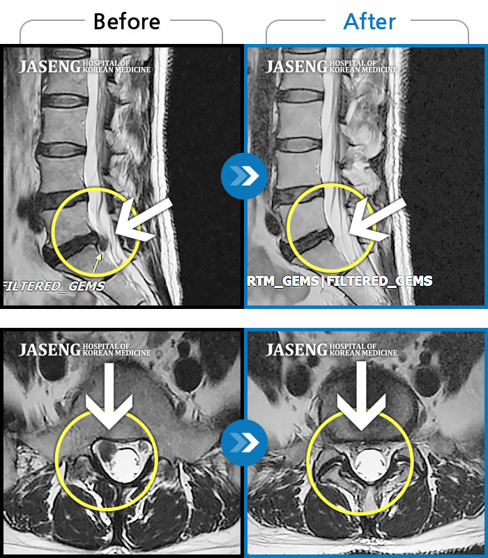 자생한방병원 치료사례 MRI로 보는 치료결과-허리 아프고 보행시 우측 다리 통증