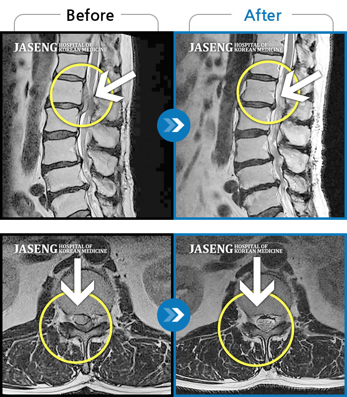 자생한방병원 치료사례 MRI로 보는 치료결과-허리 통증과 양쪽 대퇴부 전면으로 당기는 듯한 통증