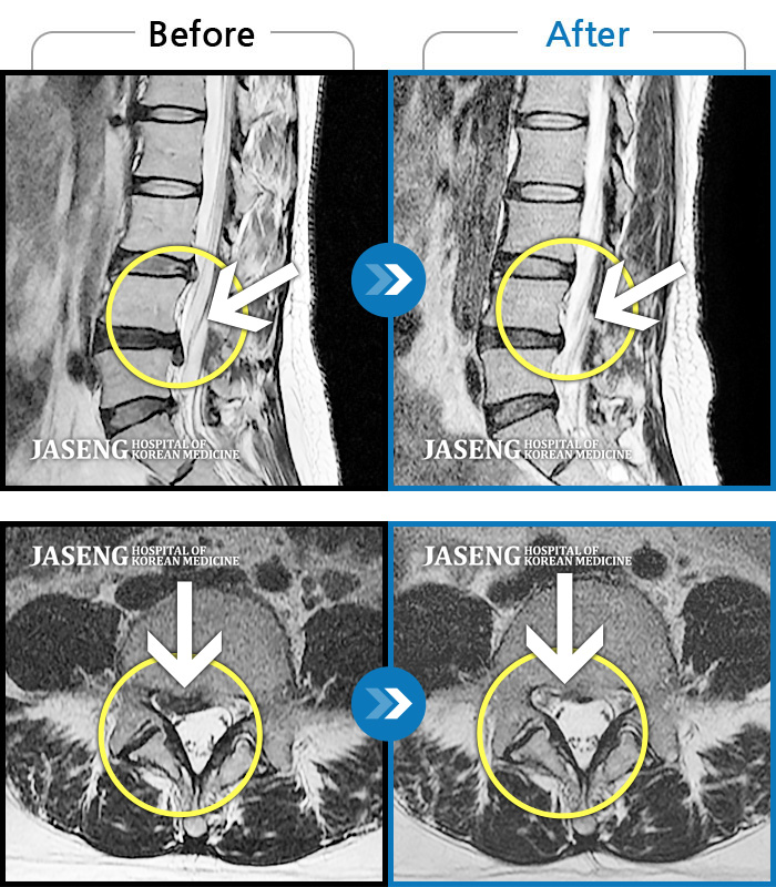 자생한방병원 치료사례 MRI로 보는 치료결과-요추 4번과 요추 5번 사이에서 탈출된 디스크가 신경막을 압박