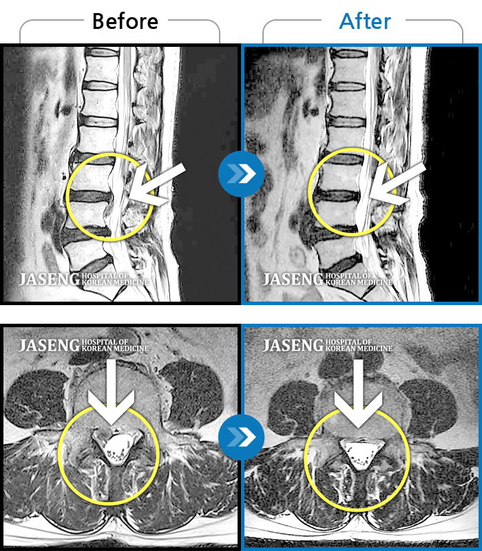 자생한방병원 치료사례 MRI로 보는 치료결과-허리의 통증과 우측 다리로 방사되는 통증